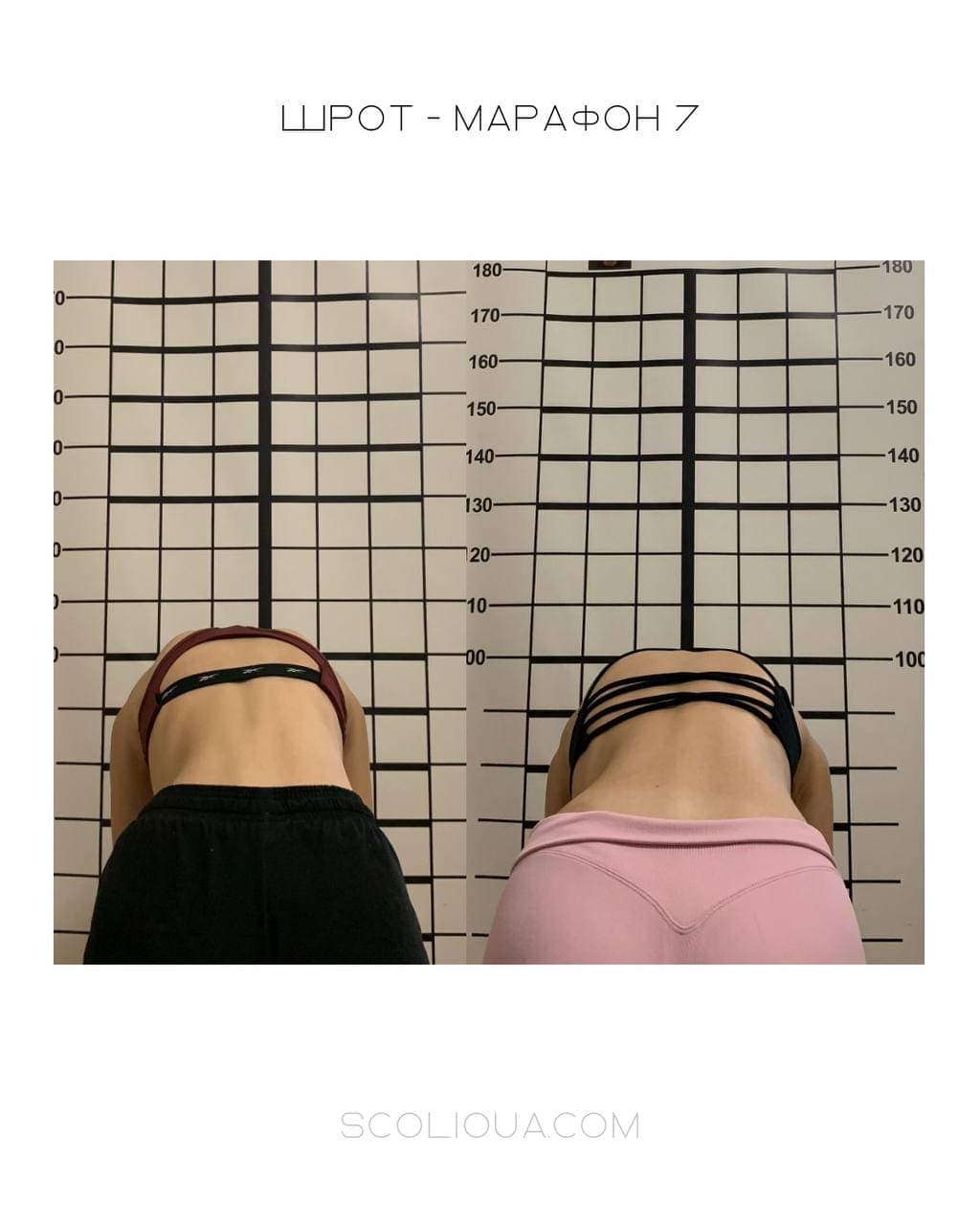 Schroth Therapy Result 4