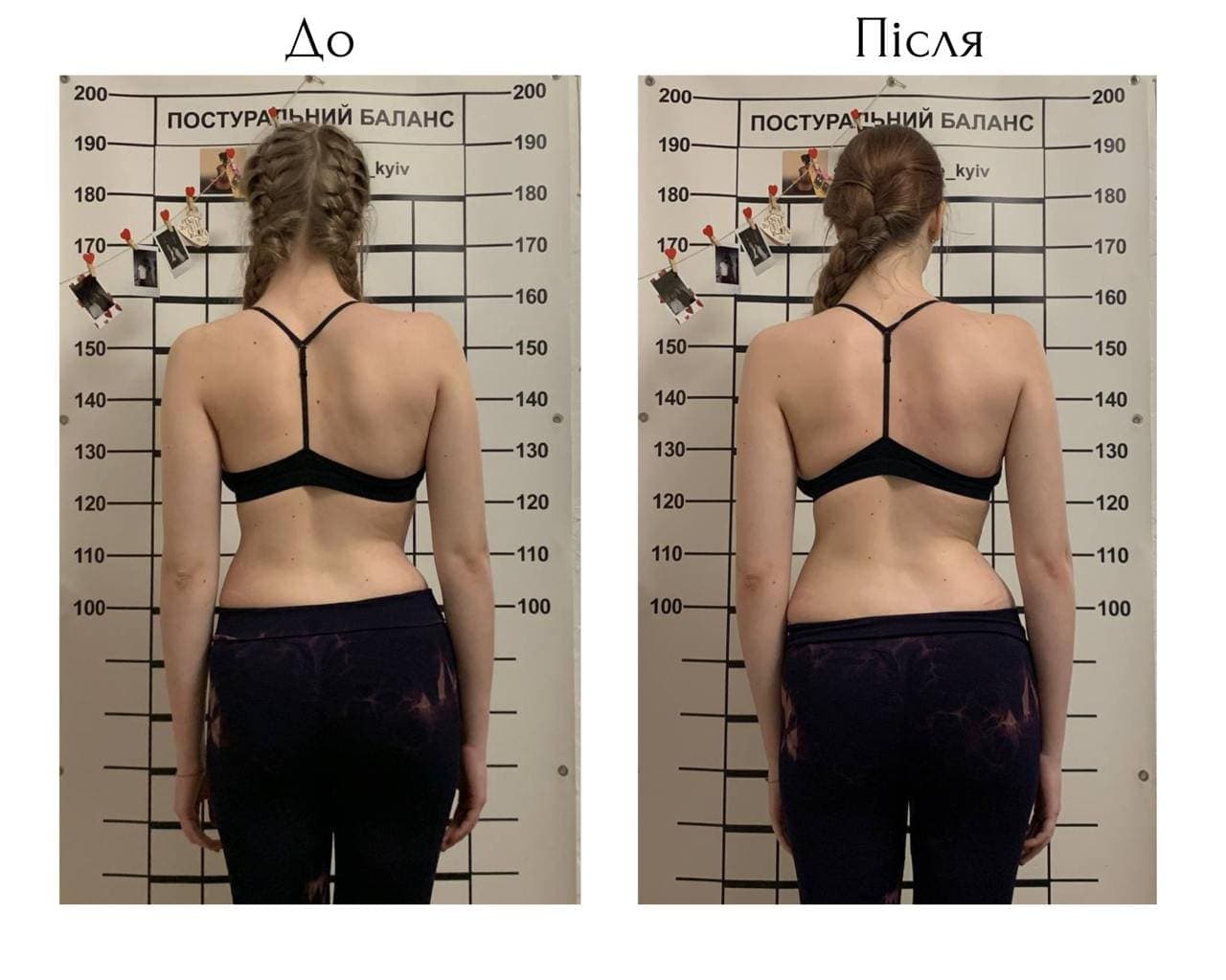 Schroth Therapy Result 7