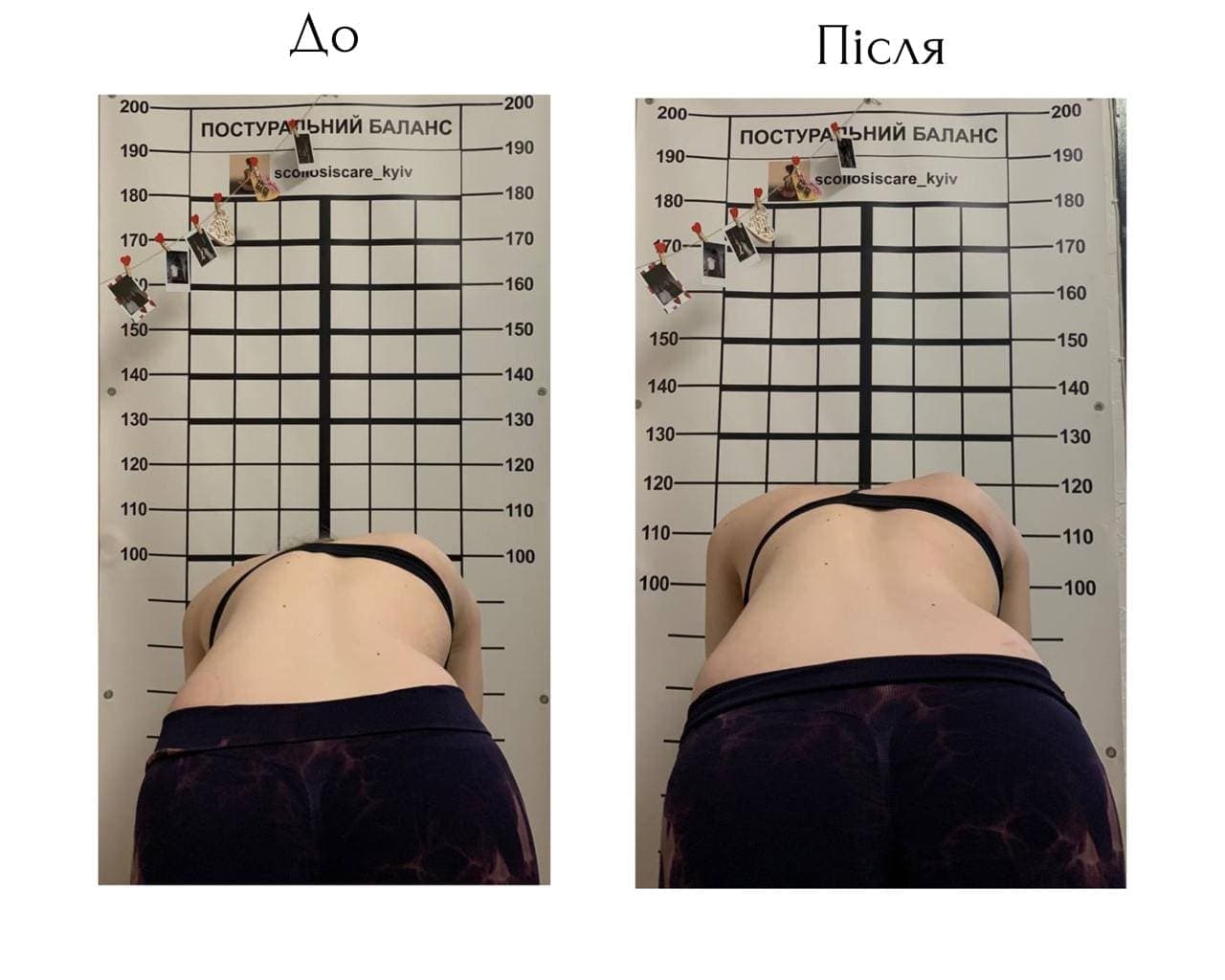 Schroth Therapy Result 8