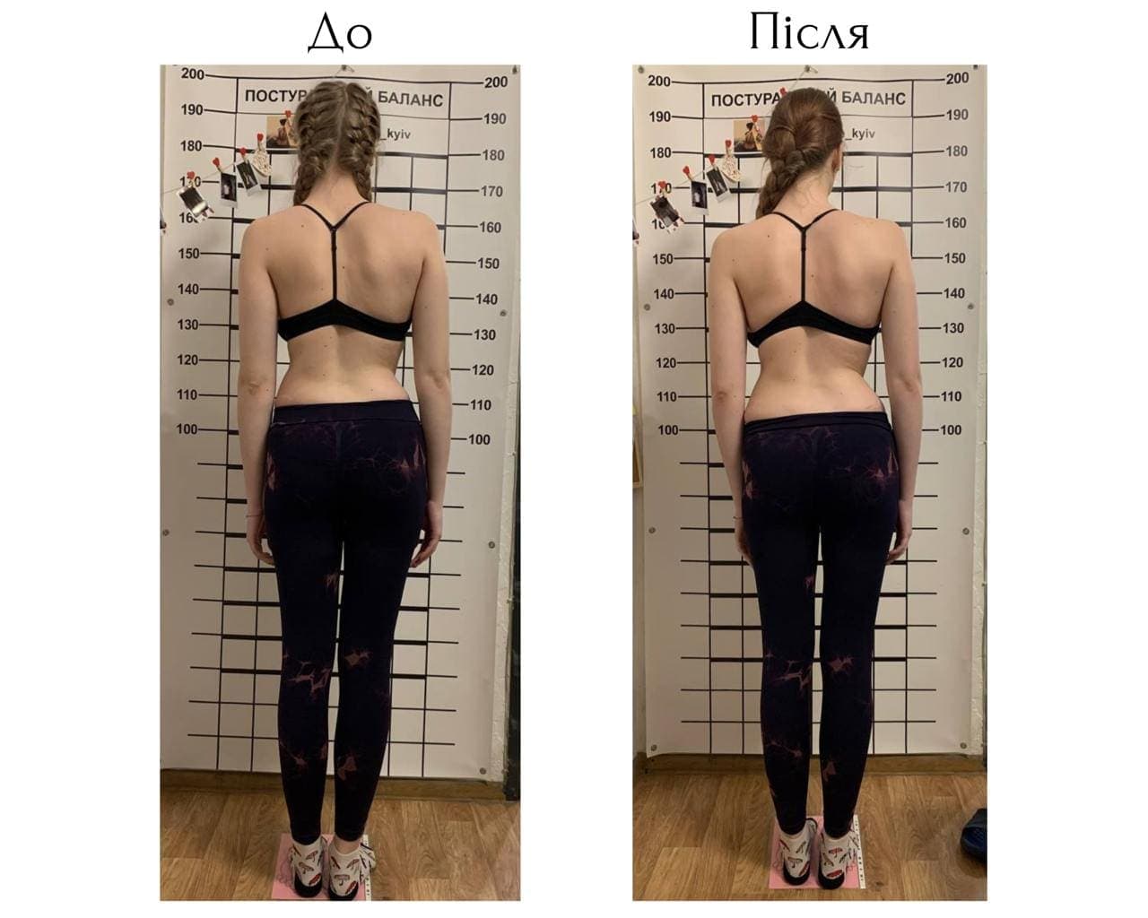 Schroth Therapy Result 9